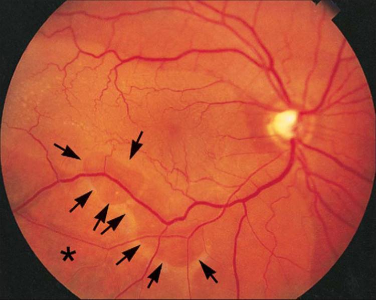 Ретиношизис сетчатки глаза: причины, диагностика и лечение