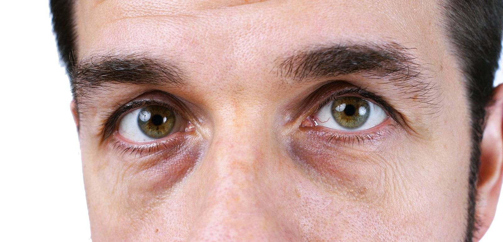 Синяки и мешки под глазами у мужчин: причины и лечение тёмных кругов и отёков, почему появляются, как избавиться, отзывы