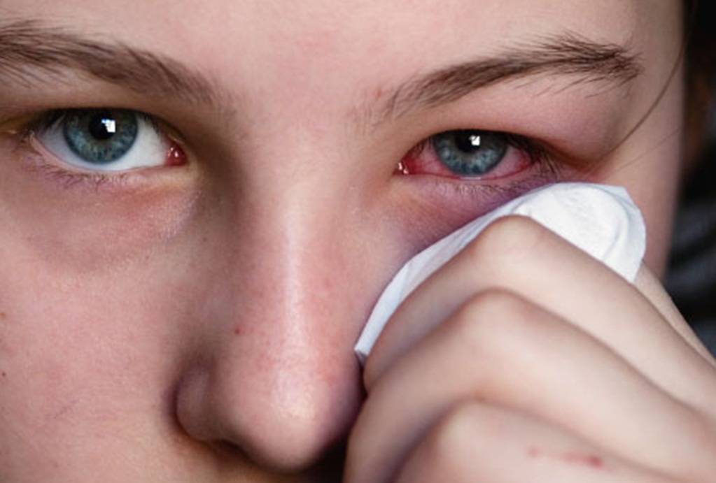Красные глаза после сна: причины, почему краснеют белки глаз утром