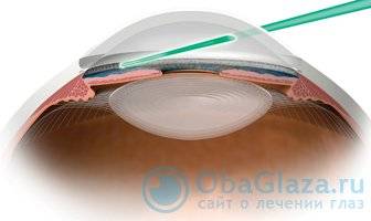 Лазерная иридэктомия при глаукоме – всё об операции