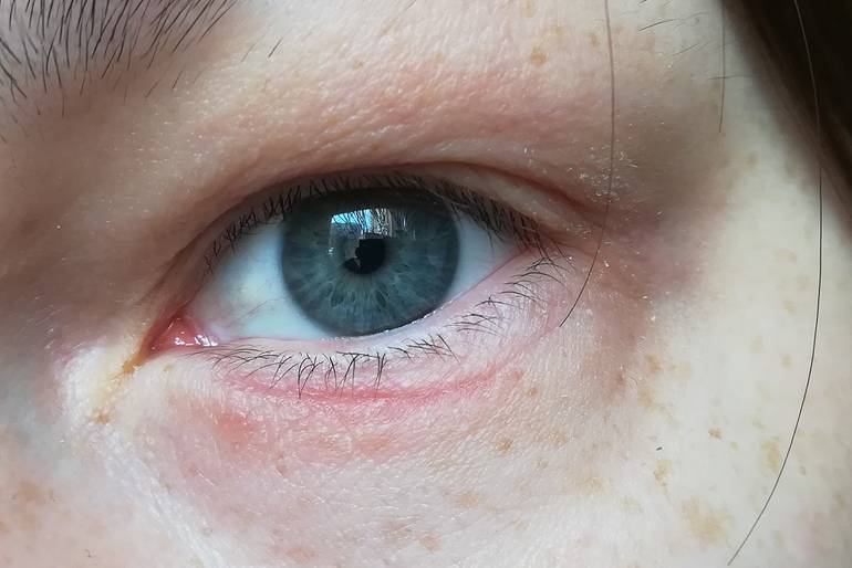 Покраснение кожи вокруг глаз: причины и лечение