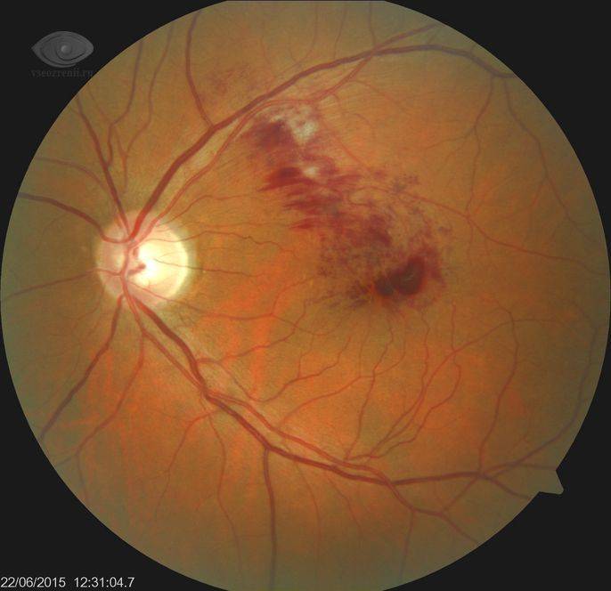 Тромбоз вен и артерий сетчатки глаза: стадии развития