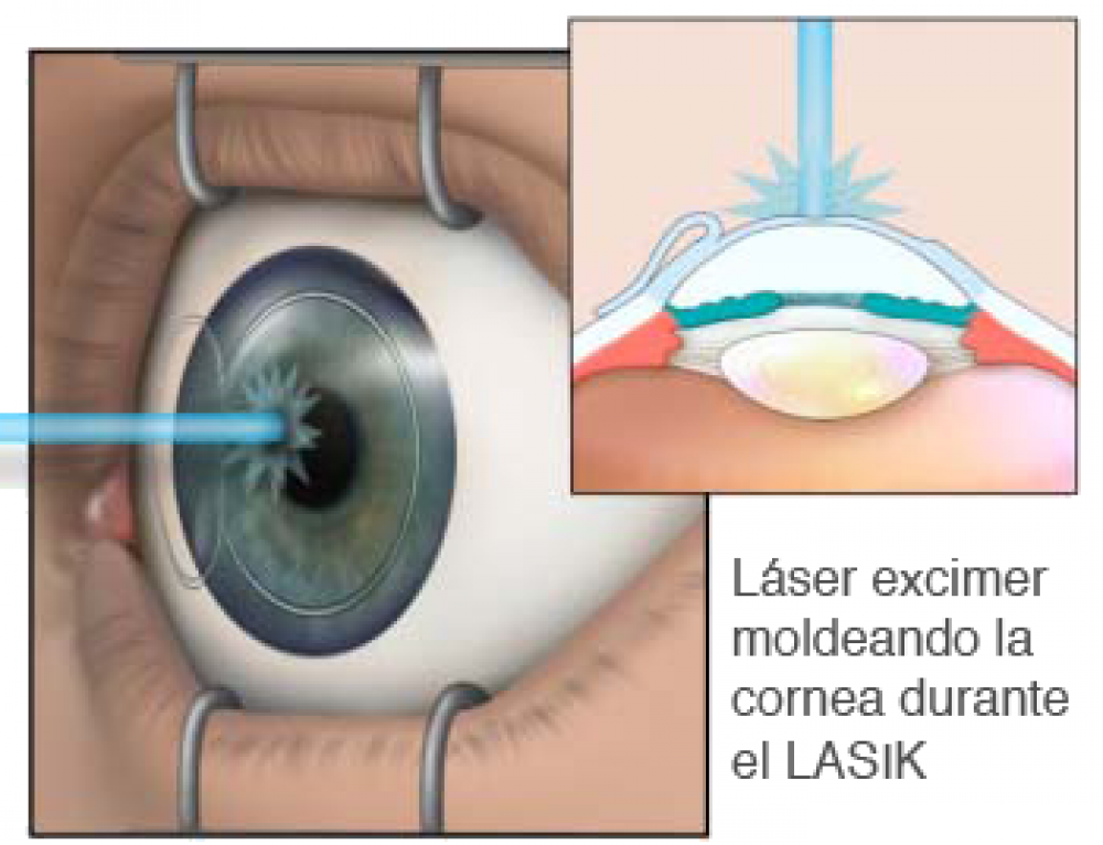 Лазерная коррекция зрения - как проходит операция, последствия, отзывы