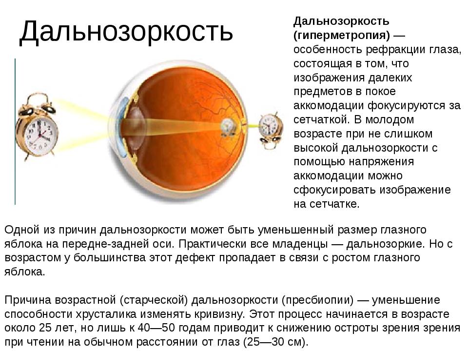 Что такое рефракция глаза и как ее лечить