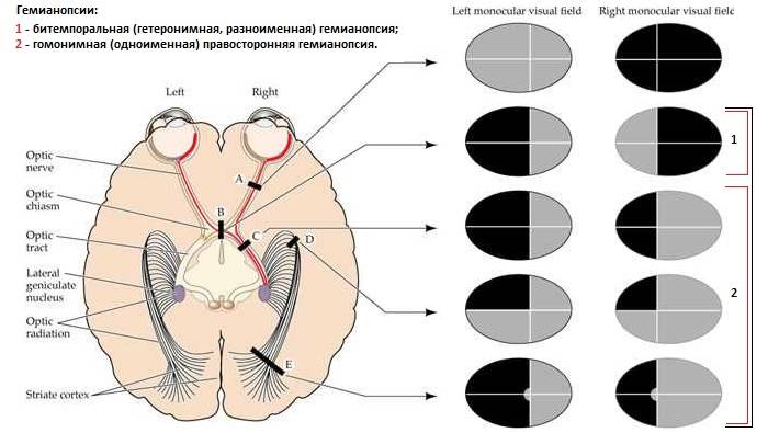 Гемианопсия (гомонимная, битемпоральная, биназальная, контралатеральная) при инсульте