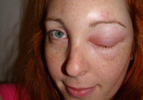 Аллергия на глазах: причины, симптомы, лечение, меры профилактики