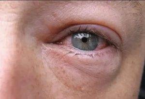 Ожог глаз кварцевой лампой: лечение, симптомы - читать