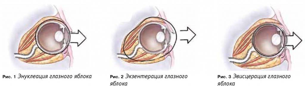 Энуклеация глаза (эвисцерация): операция по удалению глазного яблока