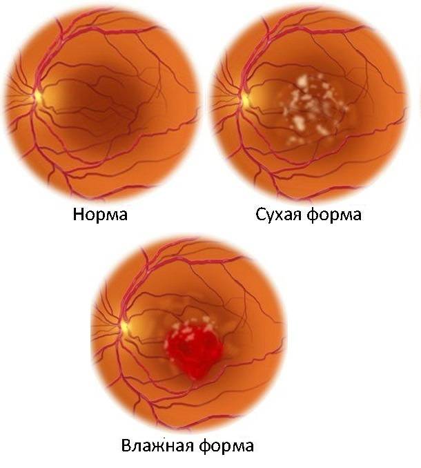 Влажная форма макулодистрофии сетчатки глаза: лечение