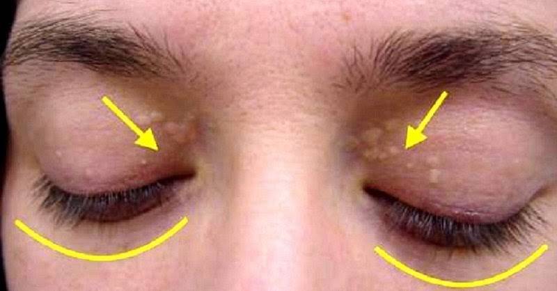 Желтое пятно глаза - причины возникновения, лечение