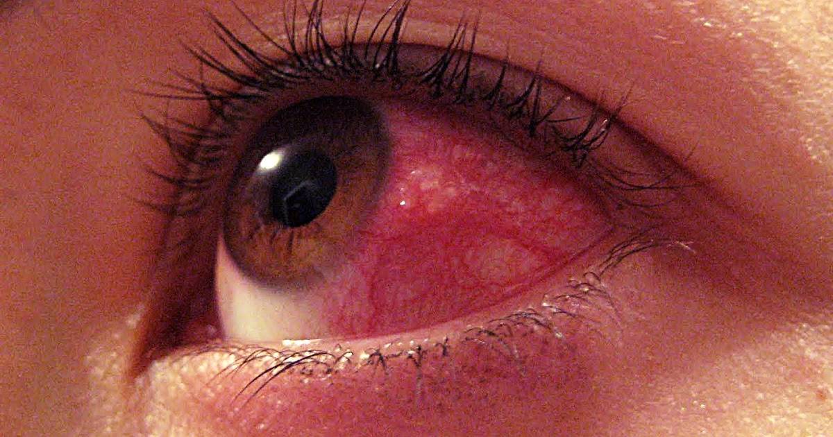 Эндофтальмит глаза – причины, симптомы и лечение эндофтальмита (фото)