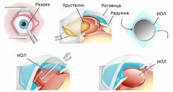 Экстракция катаракты: интракапсулярная и экстракапсулярная (с иол) | мрикрнц.рф
