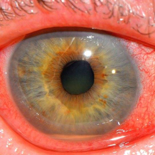 Иридоциклит: лечение, препараты, глазные капли, как и чем лечить глаза в домашних условиях, профилактика, блокада крылонебной ямки