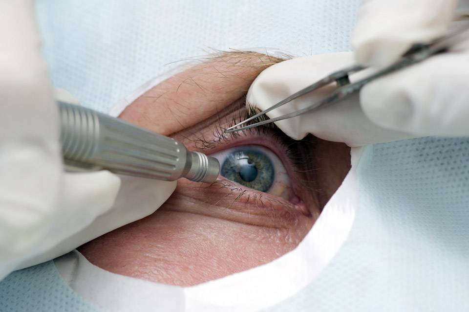 Операция катаракта замена хрусталика какой выбрать