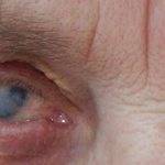 Помутнение роговицы глаза у человека (бельмо, лейкома): причины и лечение