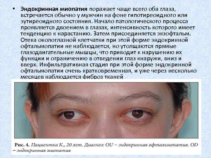 Методы терапии фиброза сетчатки глаза
