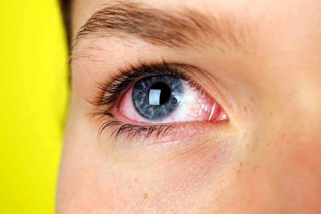 Слезоточивость глаз - причины и лечение
