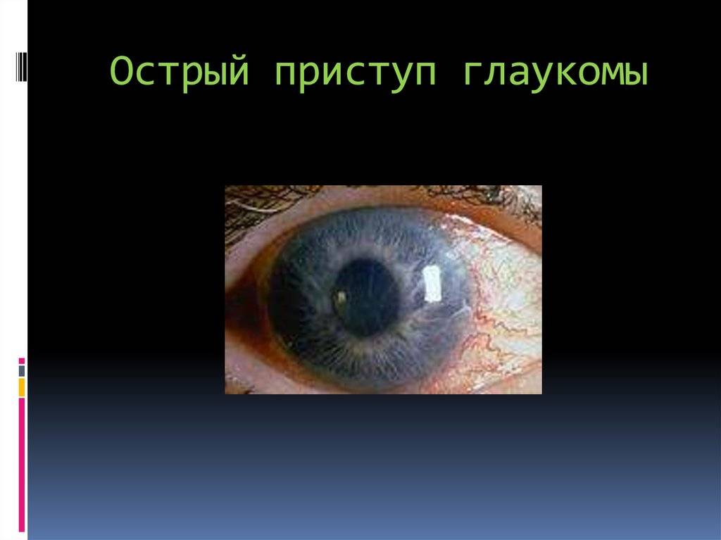 Острый приступ глаукомы: неотложная помощь, диагностика и лечение