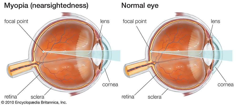 Гиперметропия средней степени: симптомы и лечение - "здоровое око"