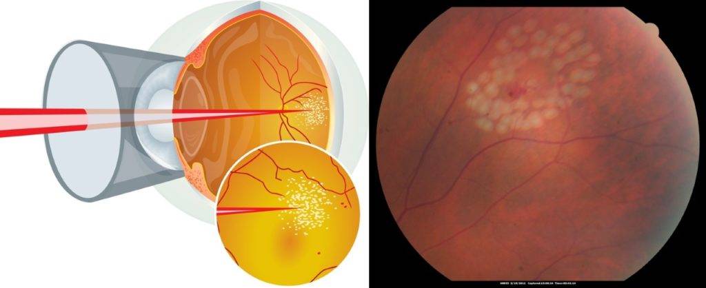 Что такое макулодистрофия сетчатки глаза? лечение современными методами