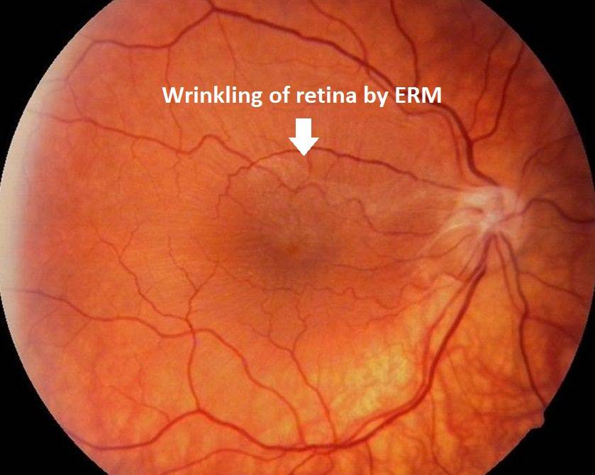 Эпиретинальная мембрана глаза: лечение или удаление?