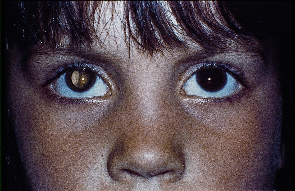 Суженные зрачки: возможные причины, профилактика и лечение - "здоровое око"