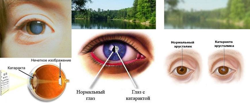 Помутнение в глазах: причины и методы лечения - "здоровое око"
