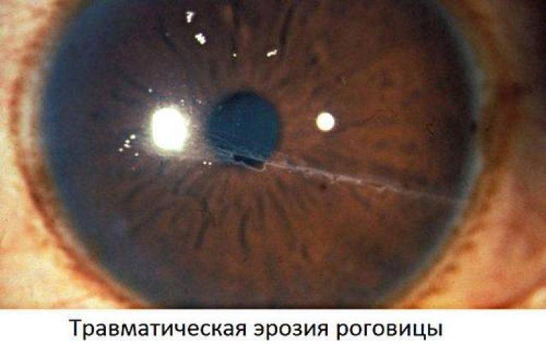 Повреждение и травма роговицы глаза: лечение и последствия