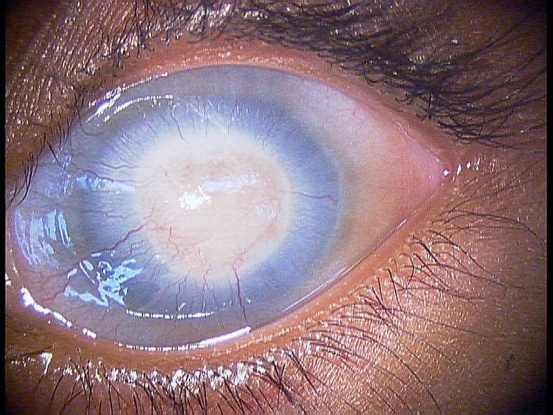 Помутнение роговицы глаза: лечение, причины возникновения, виды лейкомы и влияние на зрение