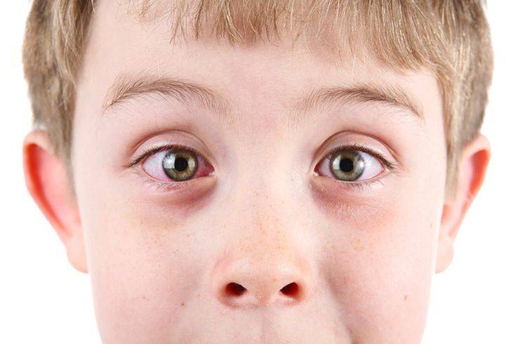 Аллергический конъюнктивит у детей - лечение и профилактика!