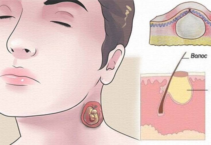 Лечение фурункула: 7 лучших методов в борьбе с чирием