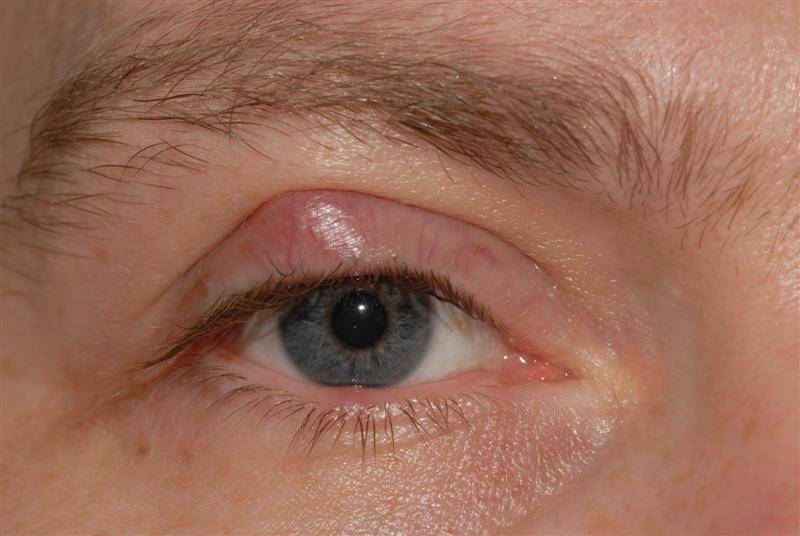 Киста глаза – причины, лечение, удаление, виды, симптомы
