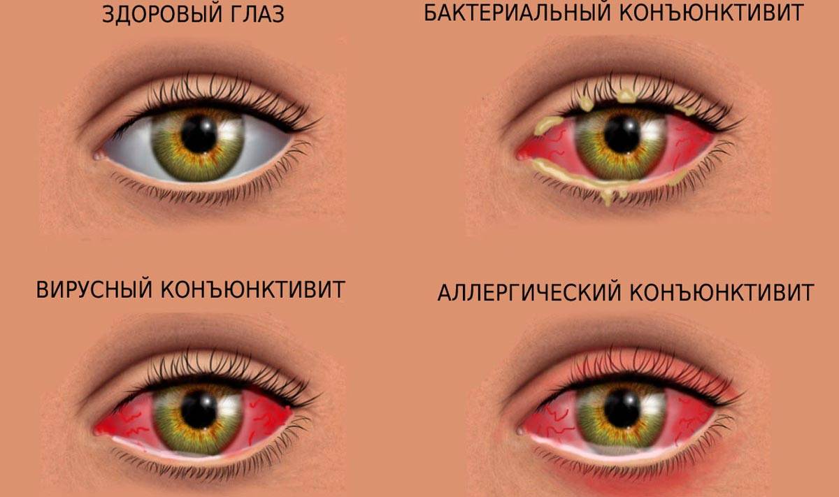 Как передается конъюнктивит - пути заражения, симптомы и лечение