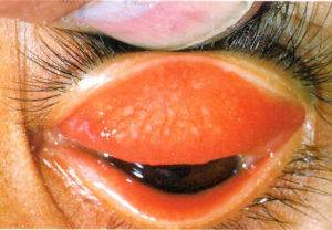Трахома глаза: возбудитель, стадии, лечение, осложнения и симптомы