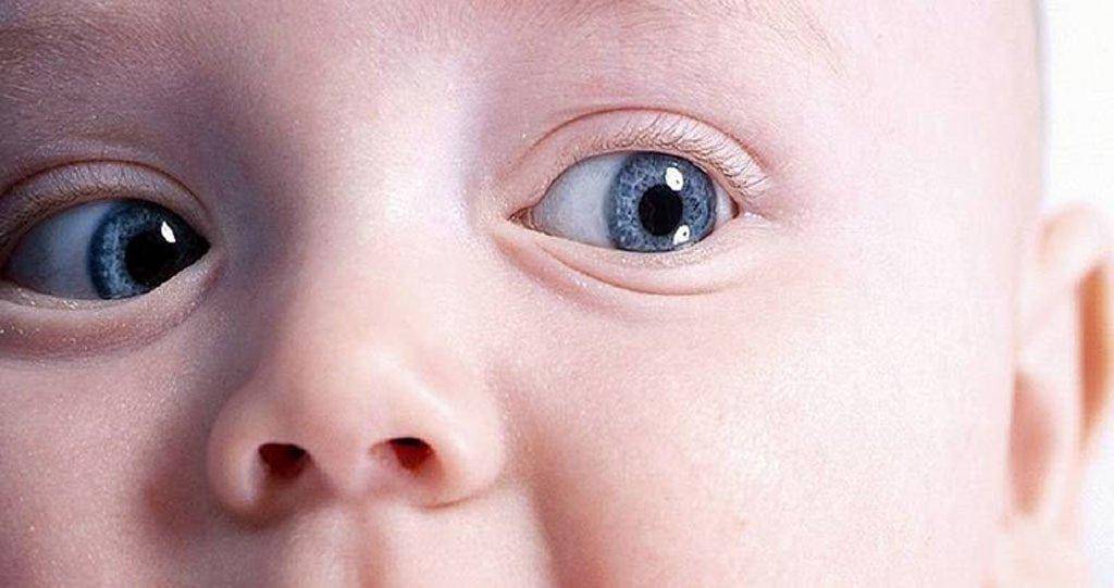 Врожденная глаукома у детей причины возникновения