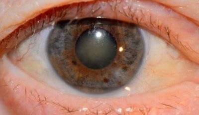 Глаукома у взрослых на ранней стадии: симптомы, признаки и лечение