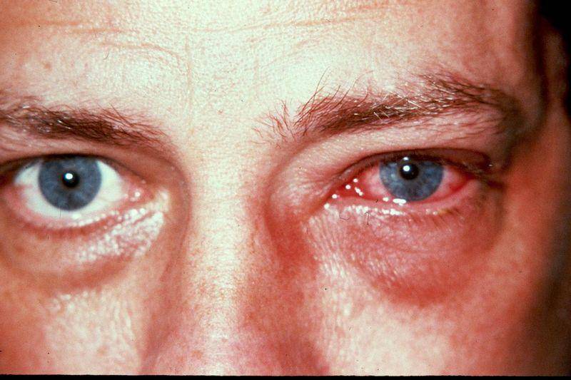 Список распространенных болезней глаз у людей с описанием и фото