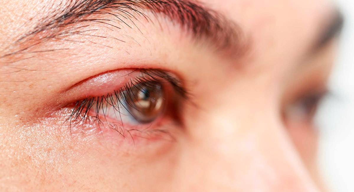 Как выглядит ячмень на глазу, его причины, симптомы и лечение
