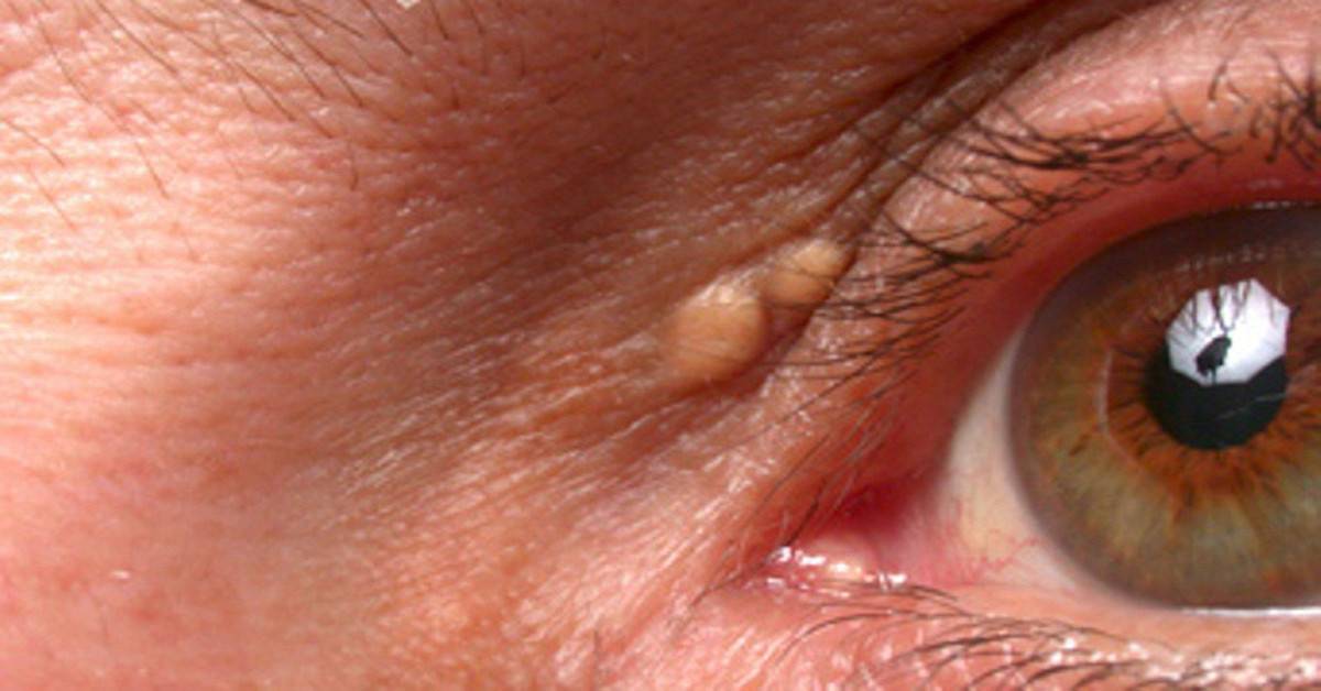 Нарост на веке глаза: лечение кисты, бородавок, папиллом и других образований, удаление, фото новообразований у человека