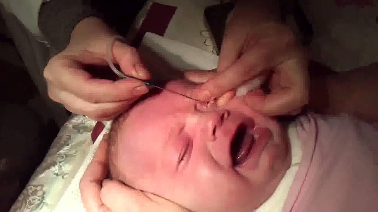 Как проводить массаж слезного канала у новорожденных
