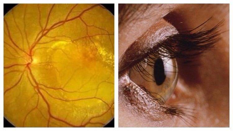 Дистрофия сетчатки глаза: что это такое, причины и лечение
