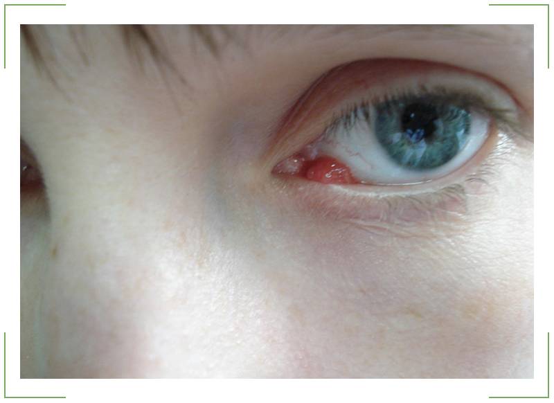 Киста на глазу: причины, симптомы и лечение
