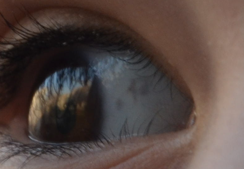 Почему появляется желтое пятно на белке глаза