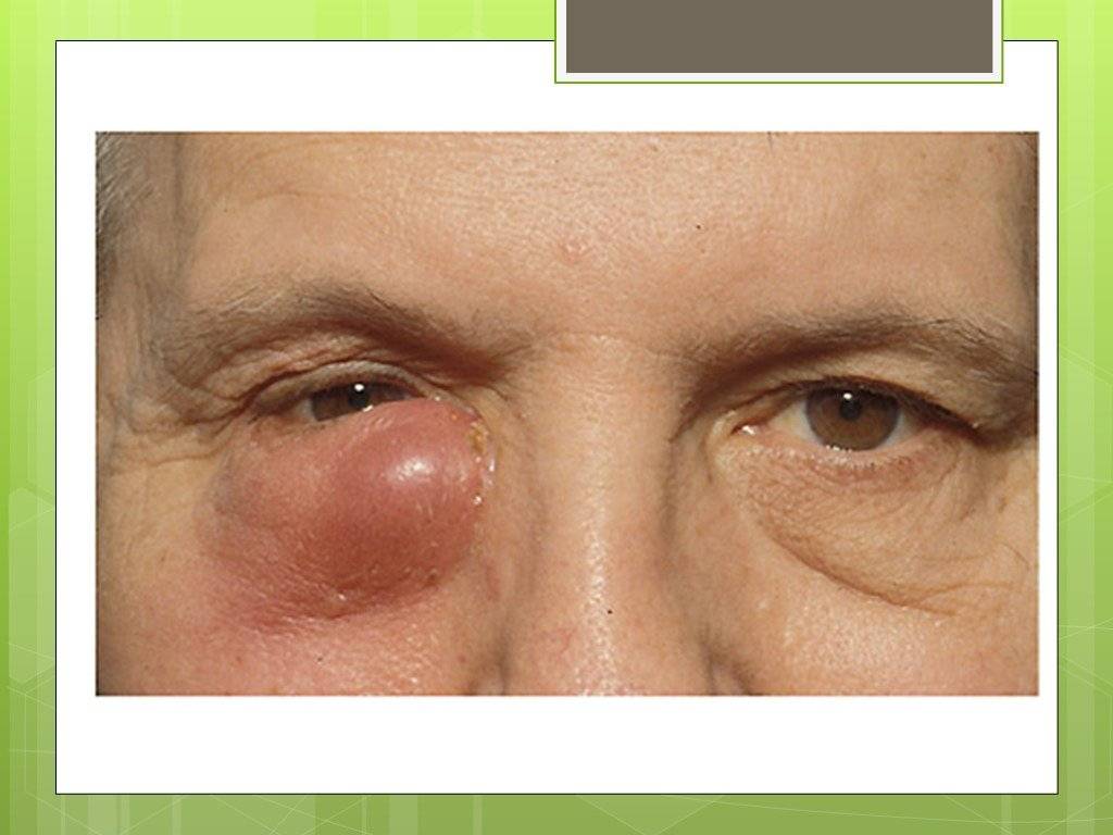 Ретинобластома глаза: симптомы, стадии, лечение, причины и осложнения