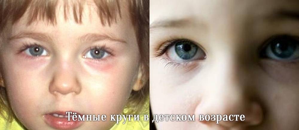 Синяки под глазами у новорожденного ребенка: причины, лечение и профилактика