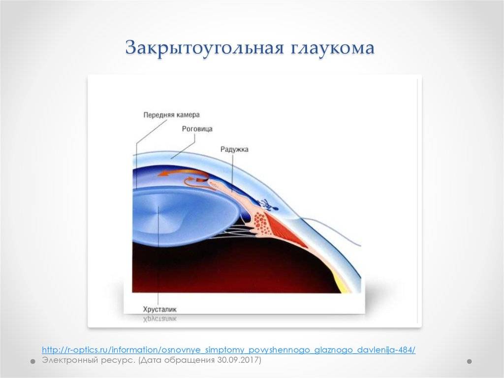 Закрытоугольная форма глаукомы, особенности лечения