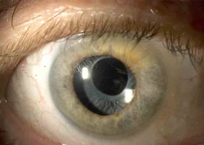 После замены хрусталика глаз видит мутно - причины и что делать - информационный портал диагностики и лечения катаракты глаза