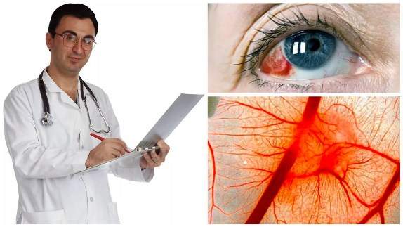 Кровоизлияние в глаз: причины и лечение, что делать при кровотечении