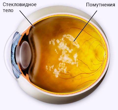 Помутнение стекловидного тела глаза: причины, лечение