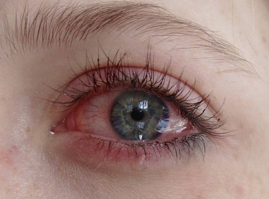 Список капель от слезоточивости глаз